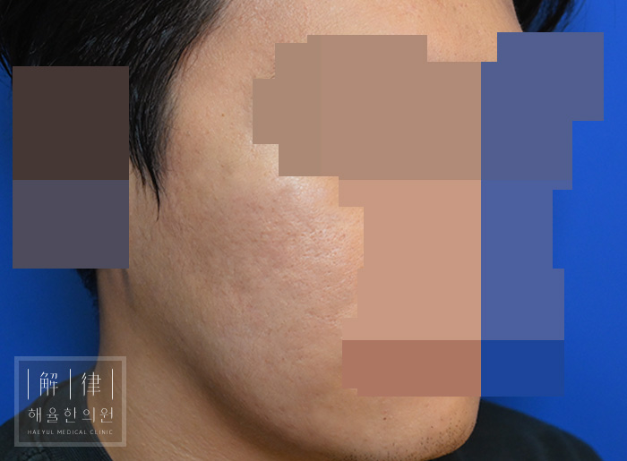 [목동점] 여드름흉터 치료 후 사진 - 해율한의원